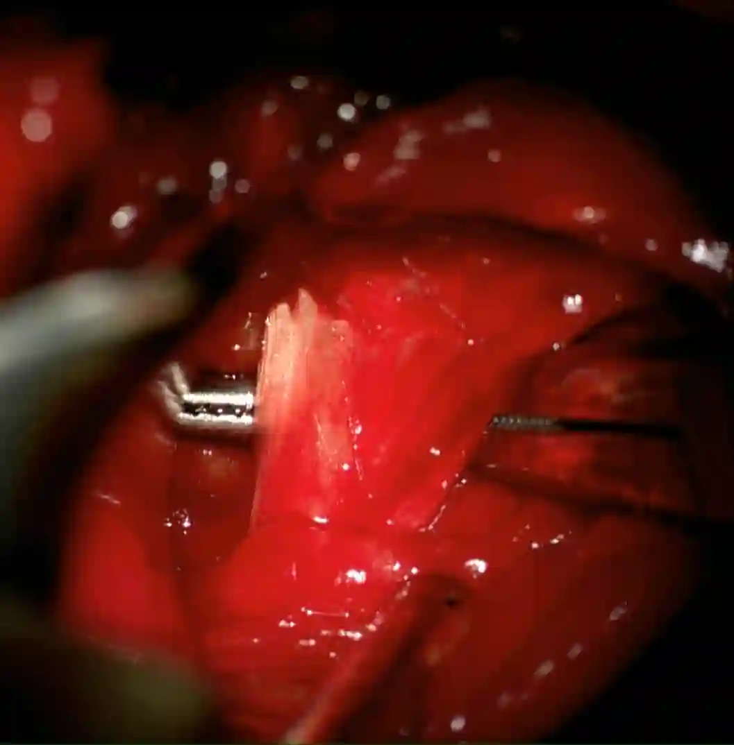 Ligamentum transversum scapulae superius intraoperativ