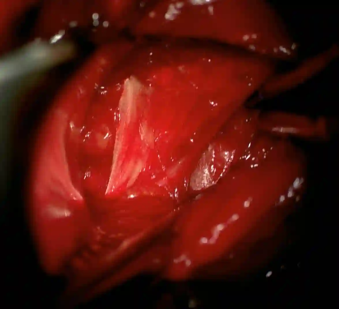 Ligamentum transversum scapulae superius intraoperativ