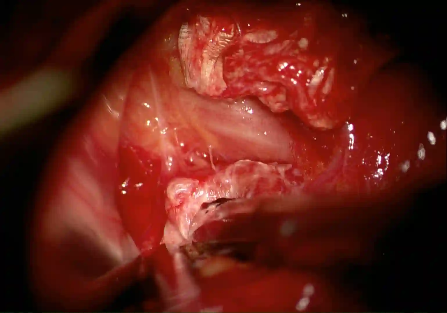 Gespaltenes Ligamentum transversum scapulae superius und Nervus suprascapularis intraoperativ
