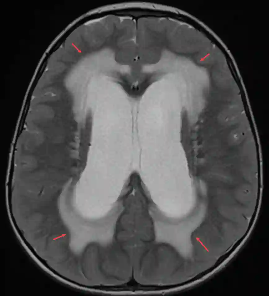 Liquordiapedese im MRI