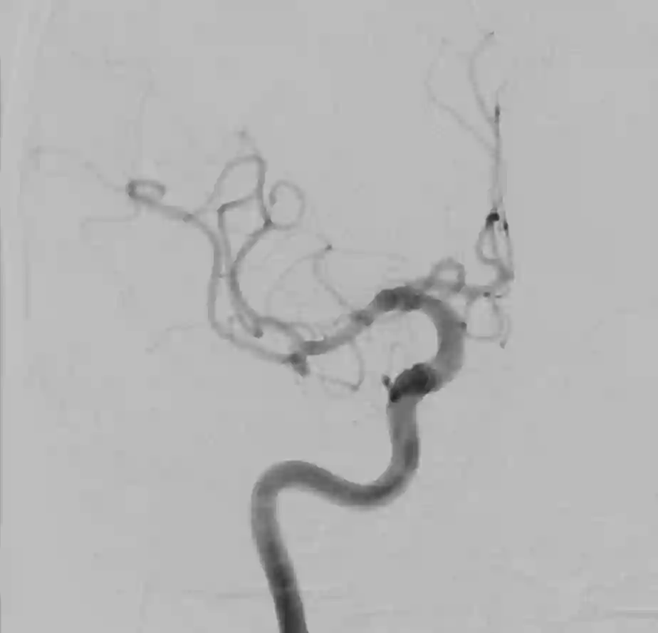 Digitale Subtraktionsangiographie Mediabifurkationsaneurysma