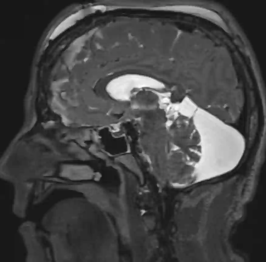 Megacisterna magna im MRI
