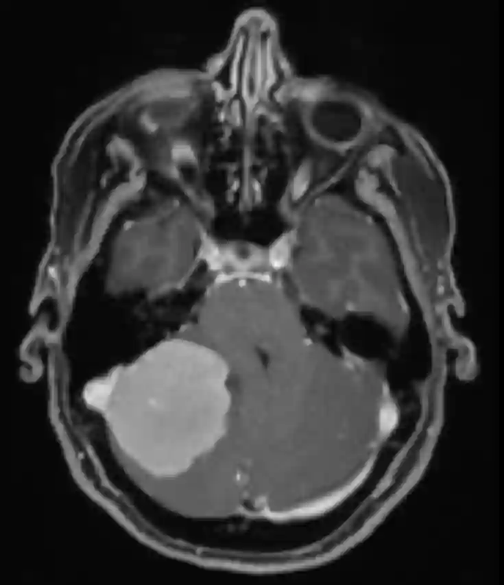 Kleinhirnbrückenwinkel Meningeom MRI