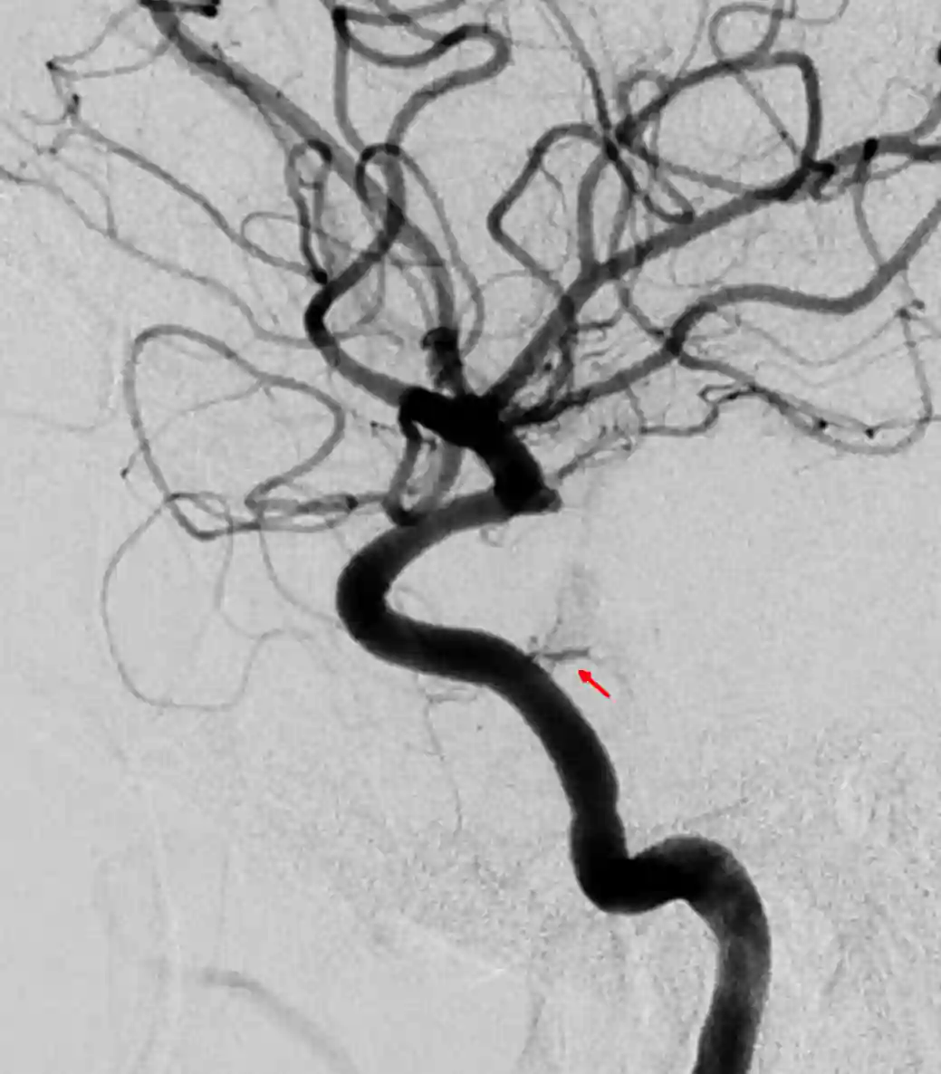 Truncus meningohypophysialis Angiographie