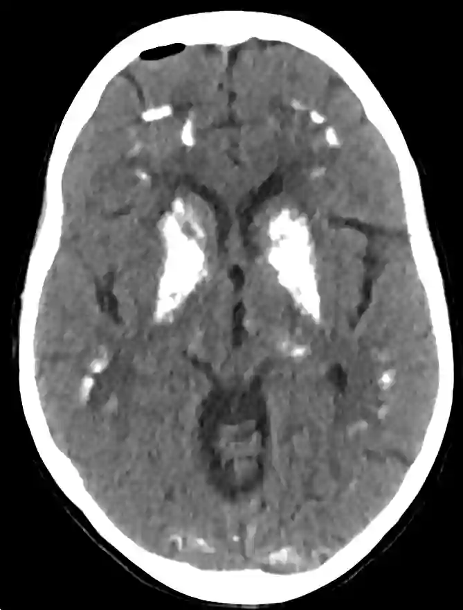 Morbus Fahr axiales CT