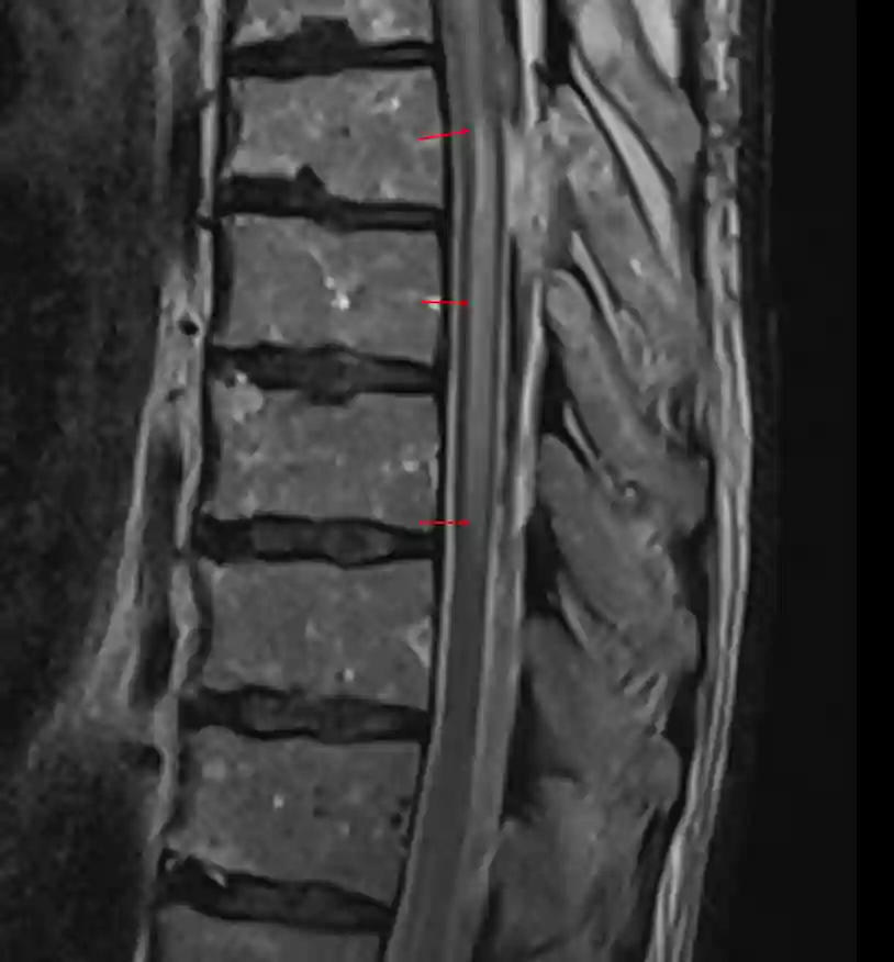 Myelopathie im MRI