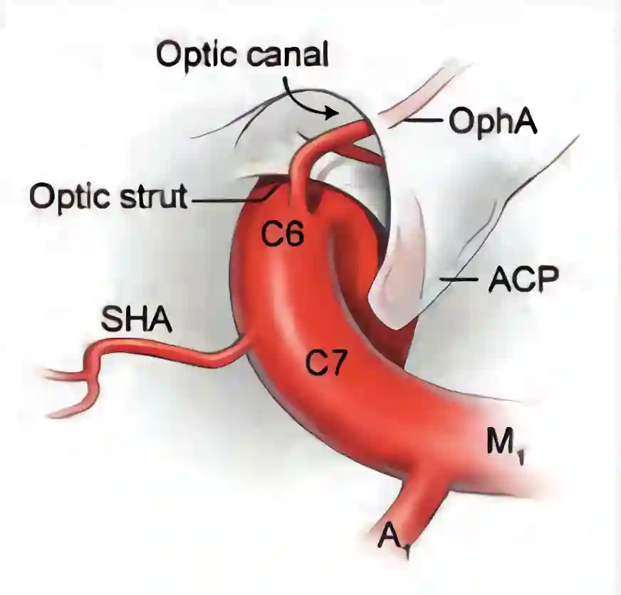 Schematische Abbildung Optic Strut