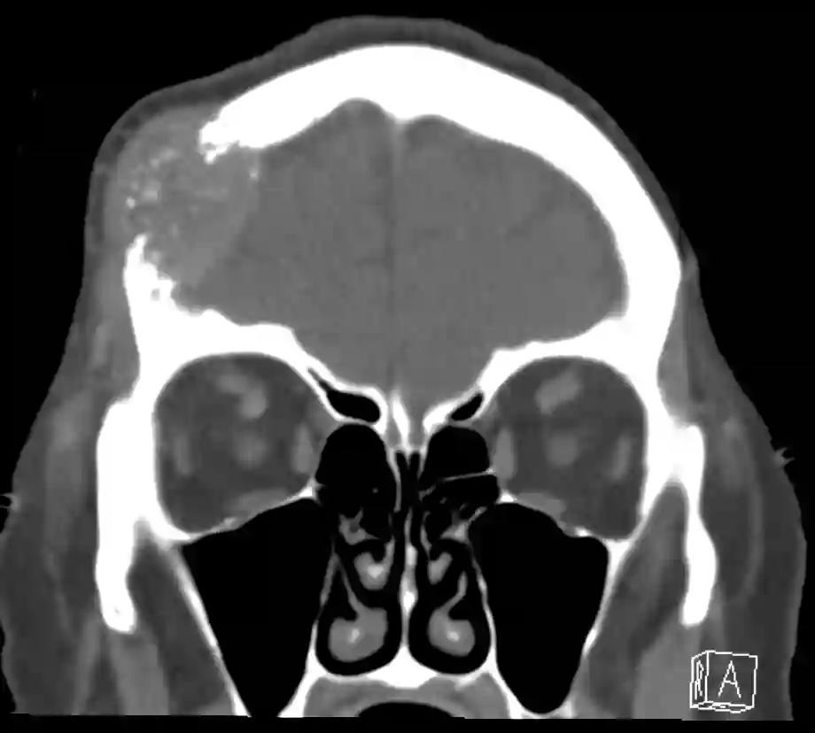 CT ossäre Hirnmetastase