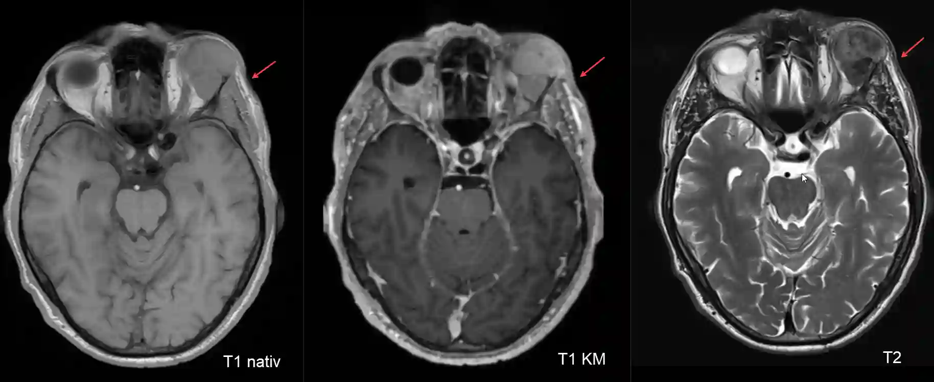 Osteoblastisches Osteosarkom der Orbita im MRI