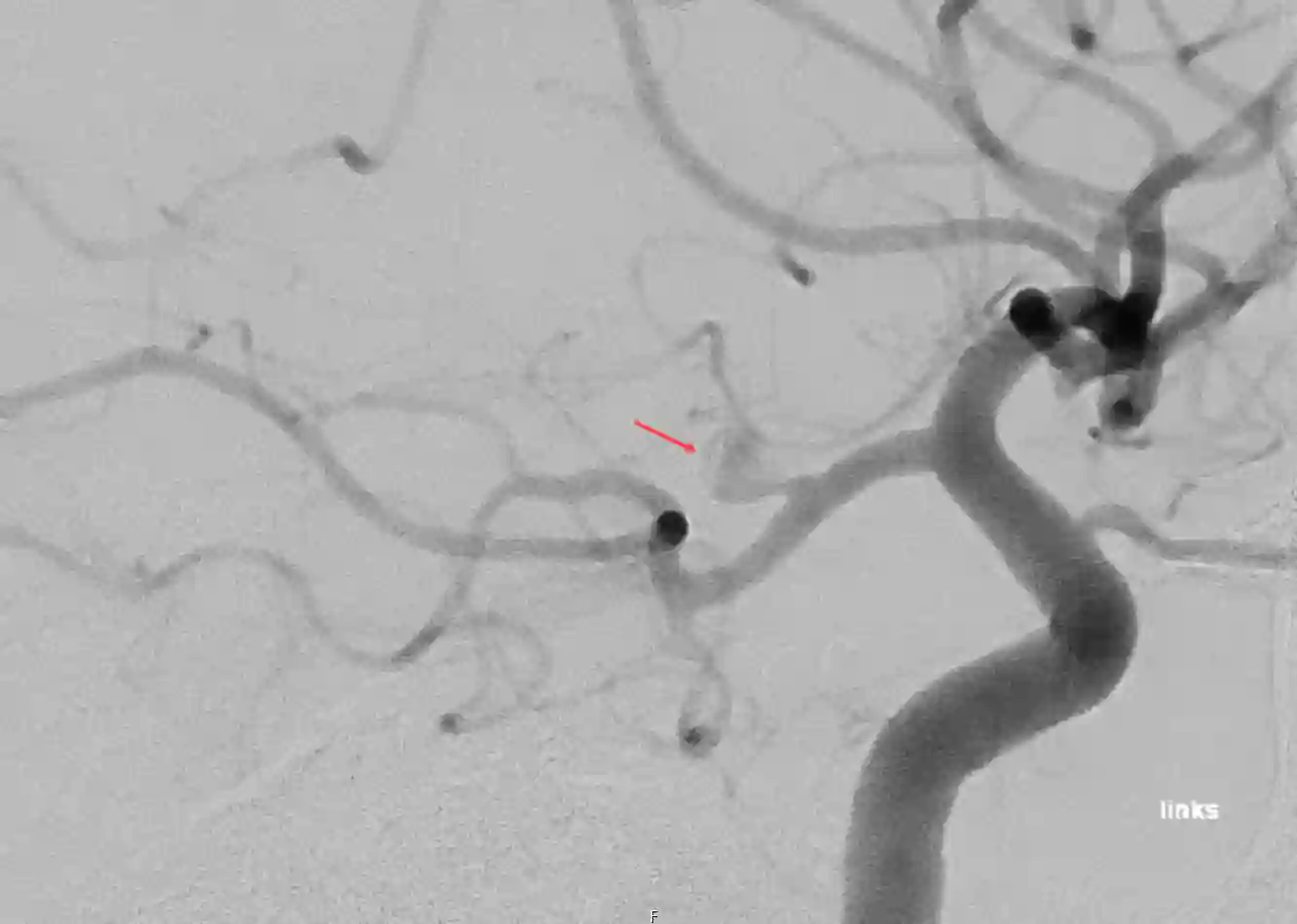 PCOM Aneurysma Angiographie