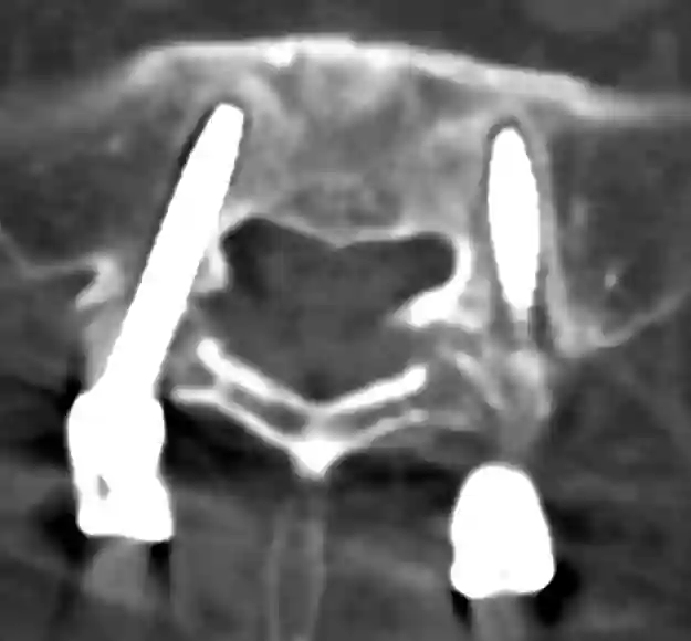 CT Pedikelschraubenlockerung