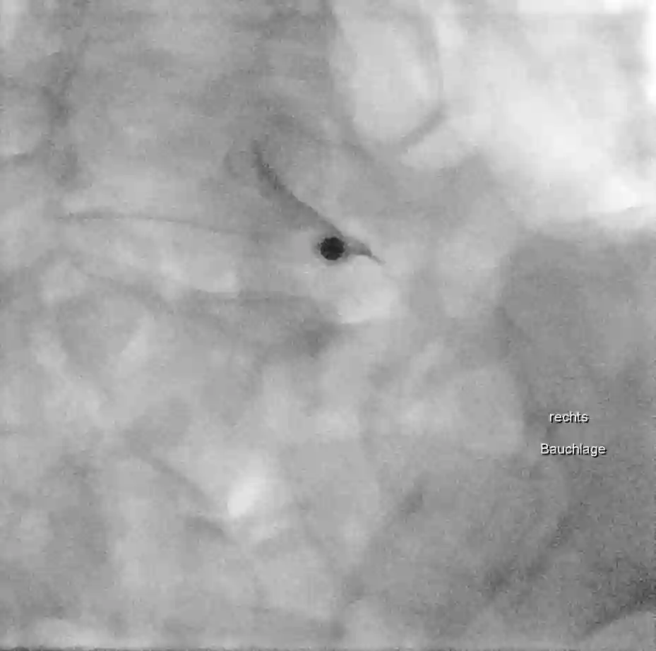 Nervenwurzelinfiltration Durchleuchtung