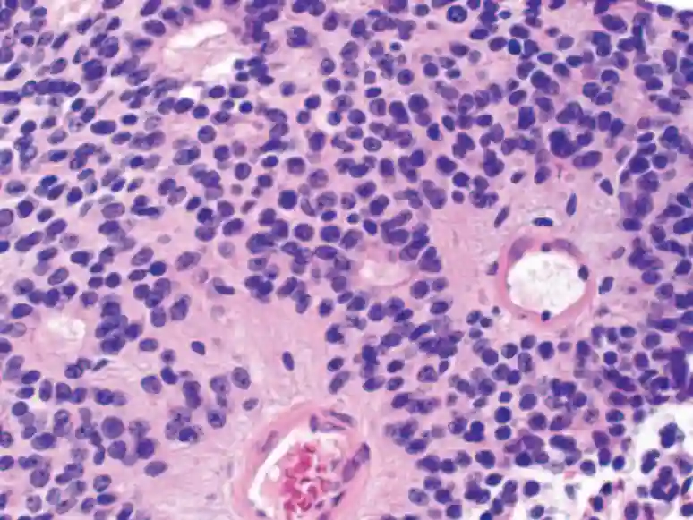 Histopathologie perivaskuläre Pseudorosette