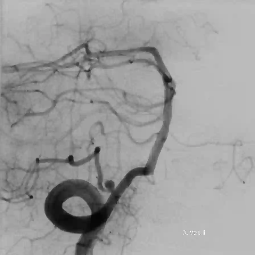 PICA Aneurysma DSA