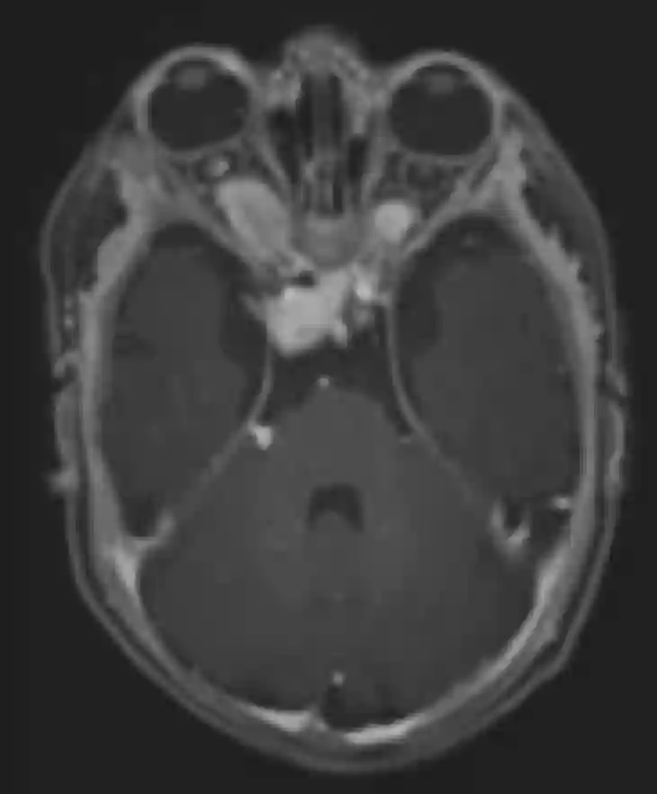 Optikusgliom MRI