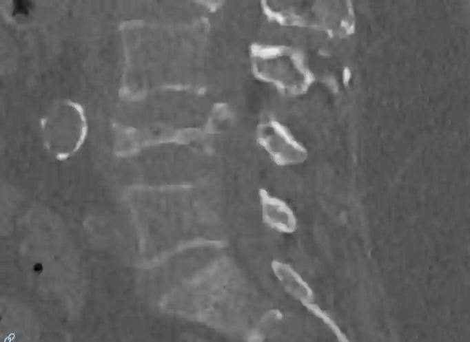 Plattwirbel CT