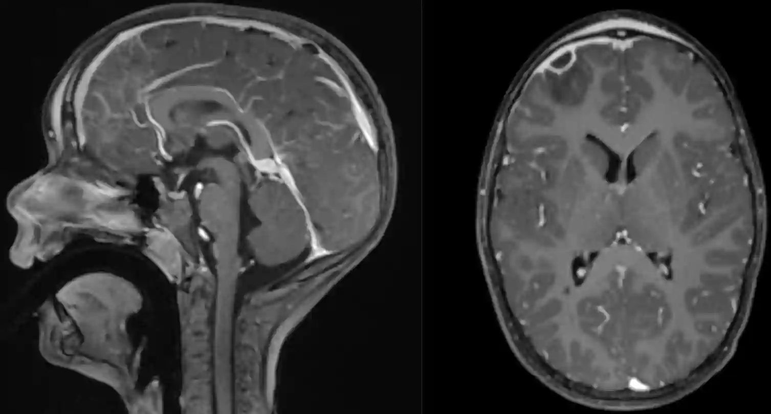 Pott Puffy Tumor