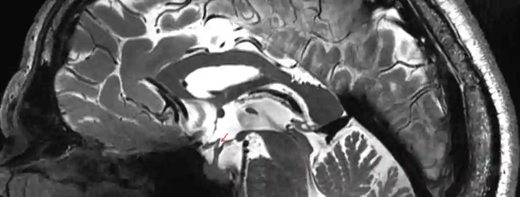 Recessus infundibuli im MRI