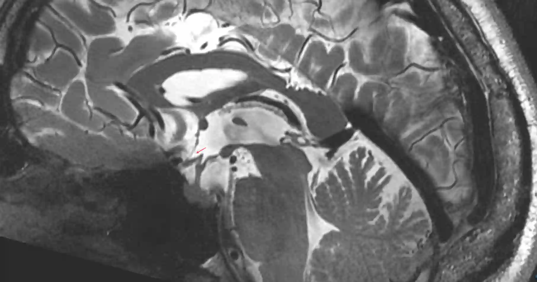 Rercessus supraopticus im MRI