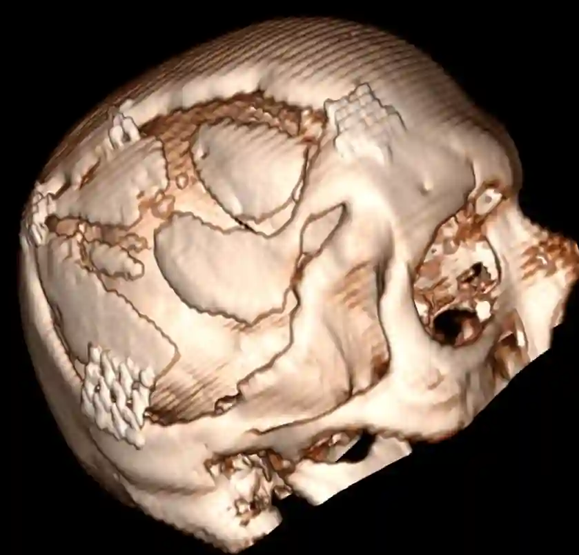 Knochendeckelresorption CT Rekonstruktion