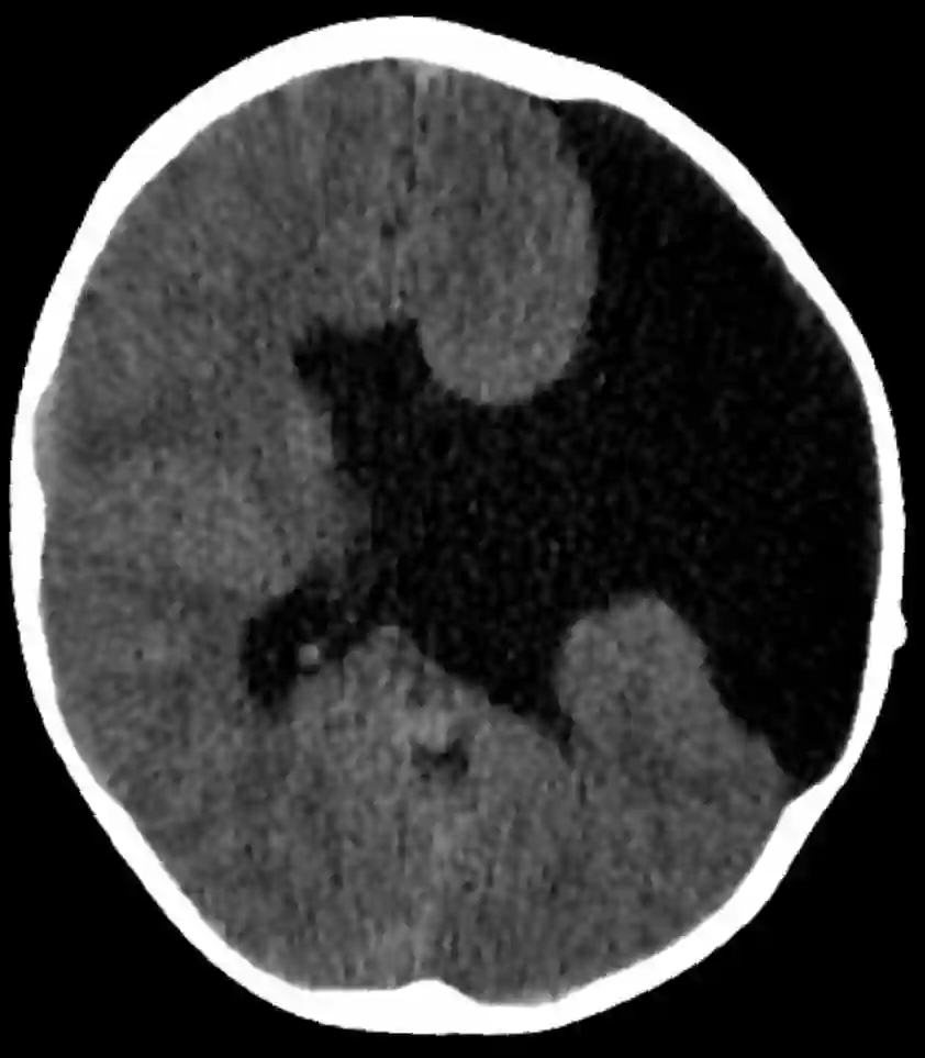 Schizencephalie CT