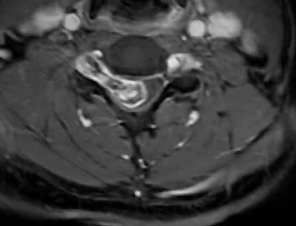 Schwannom im MRI