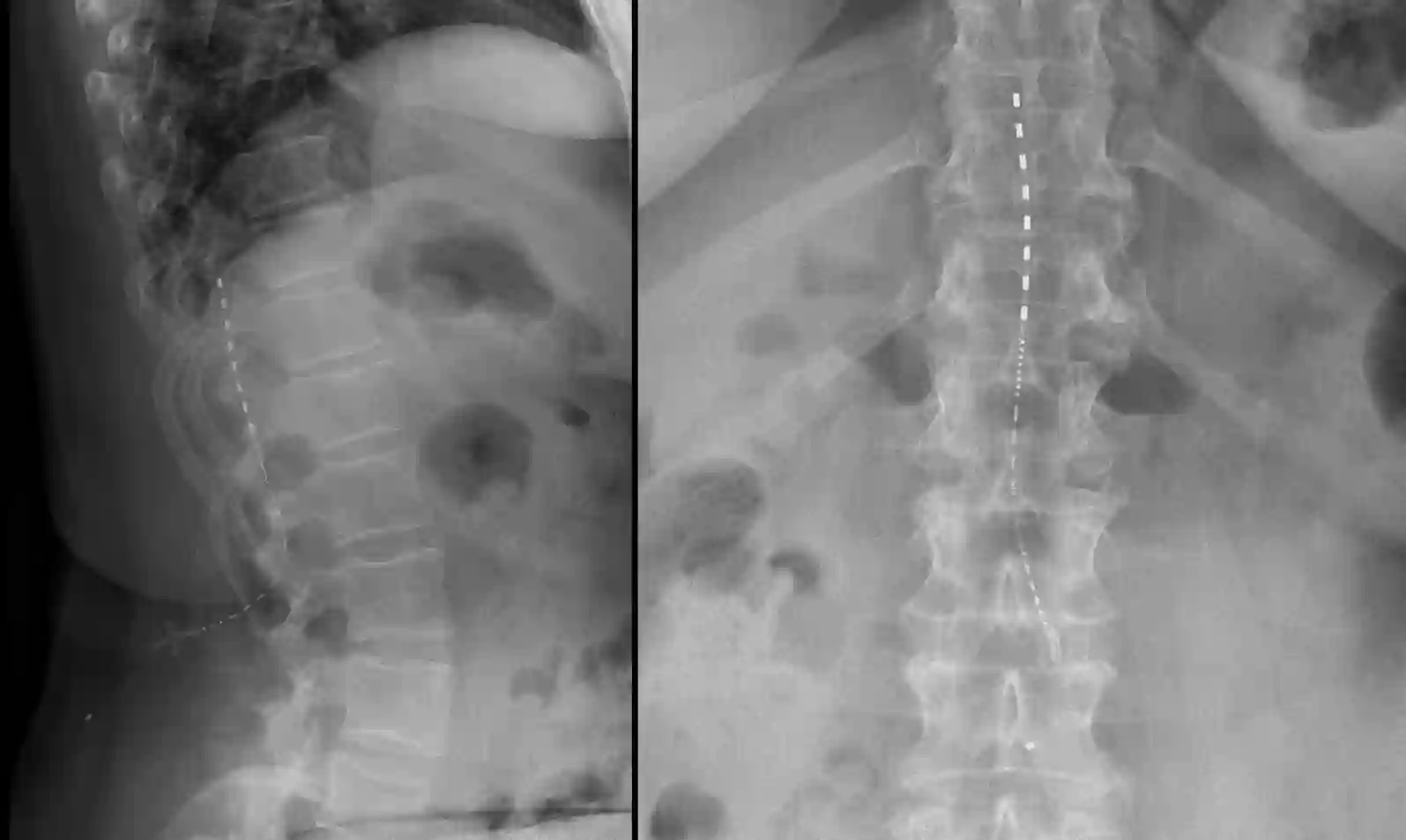 Stimwave Freedom-8A spinal cord stimulation (SCS)