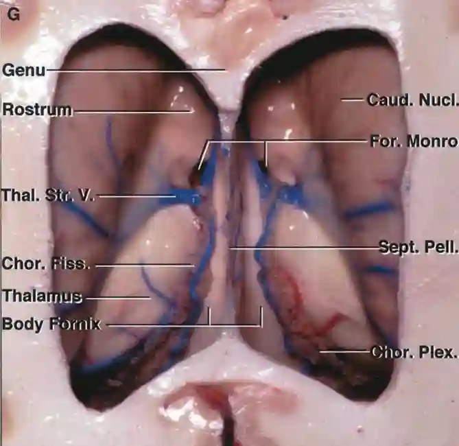 Anatomie des Seitenventrikels