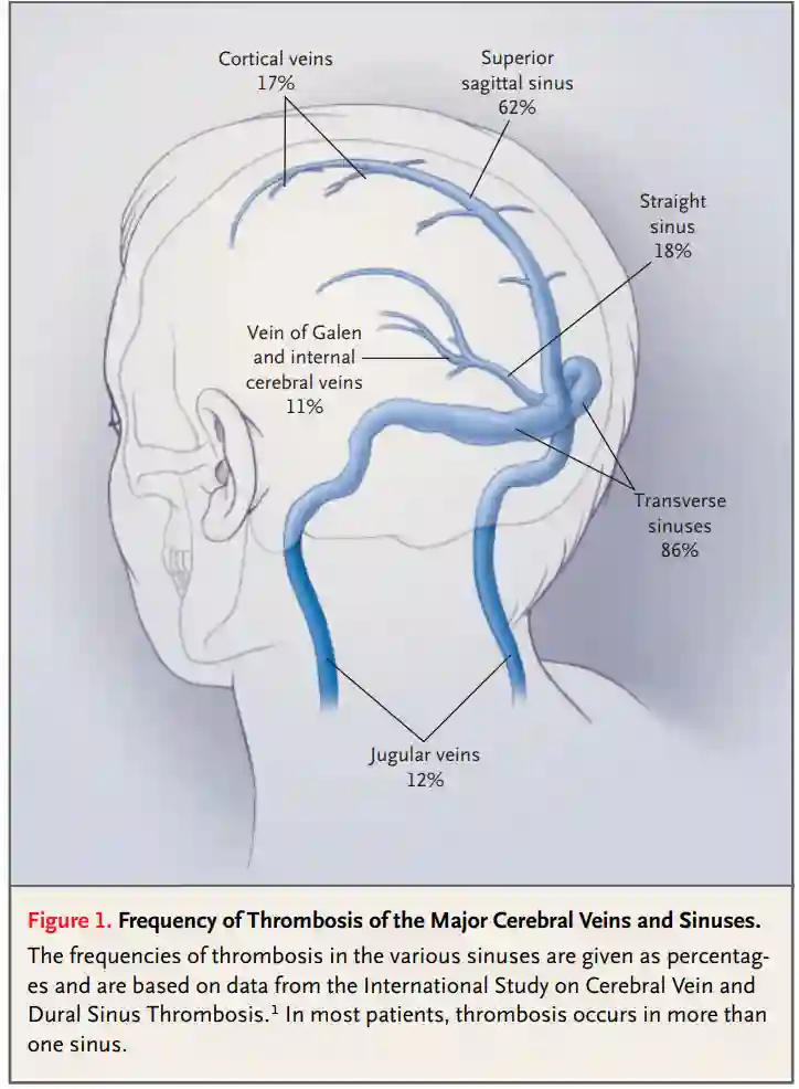 Verteilung Sinusvenenthrombose.