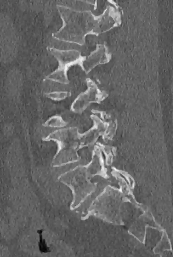 Spondylolyse LWK5/SWK1 im CT