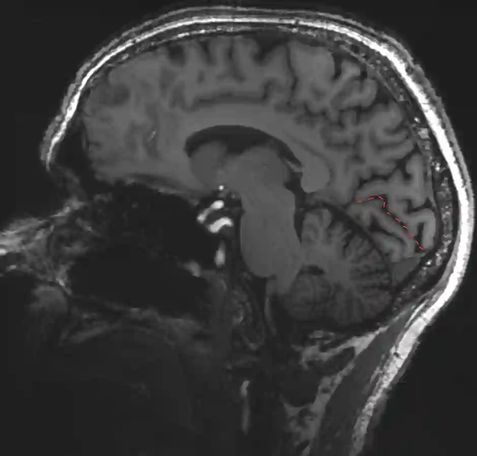 Sulcus calcarinus im MRI