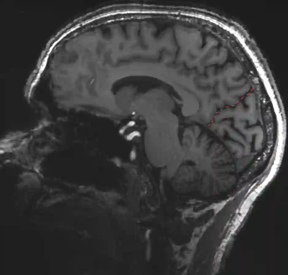 Sulcus parietooccipitalis im MRI