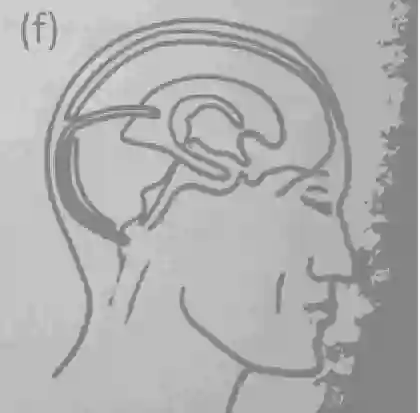 Schematische Abbildung Torkildsen Shunt