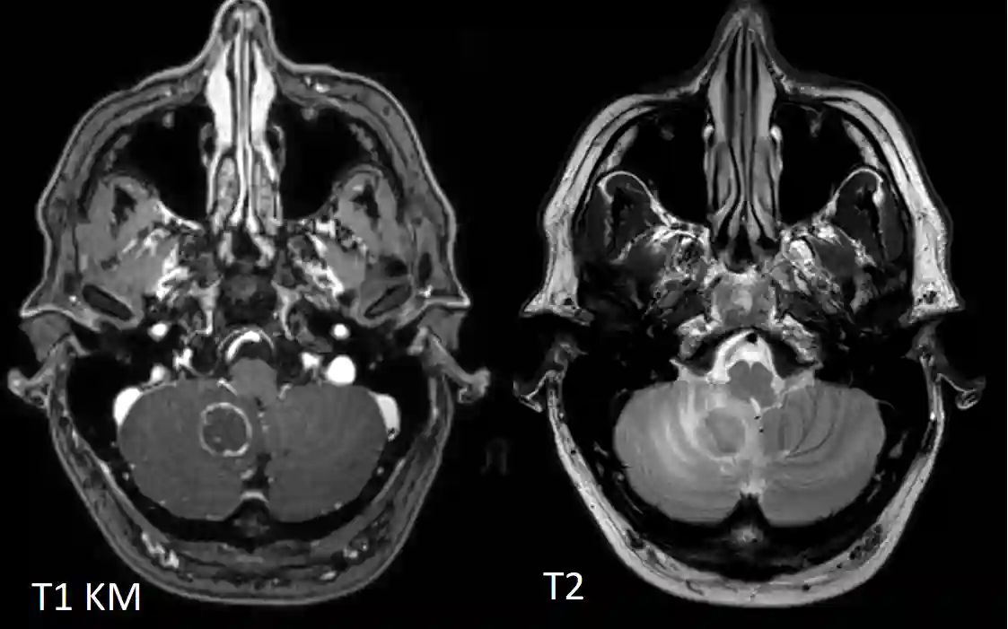 Cerebelläre Neurotoxoplasmose MRT