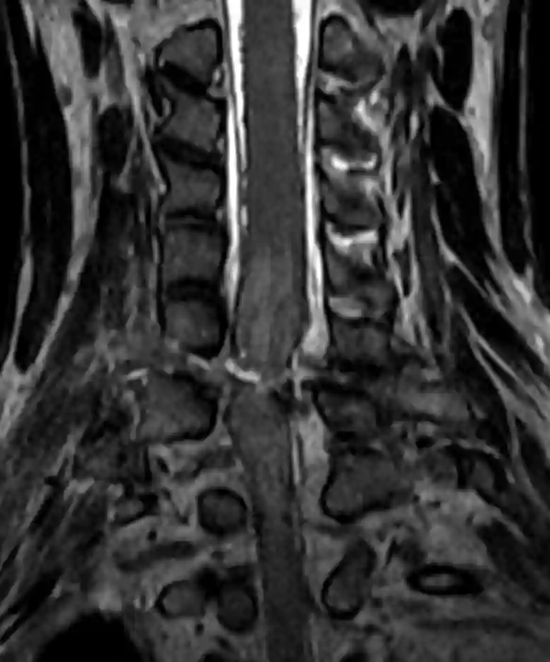 Partielle traumatische Myelotomie