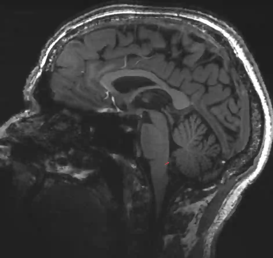 Velum medullare inferius im MRI