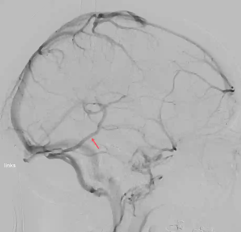 Labbé Vene in der digitalen Subtraktionsangiographie