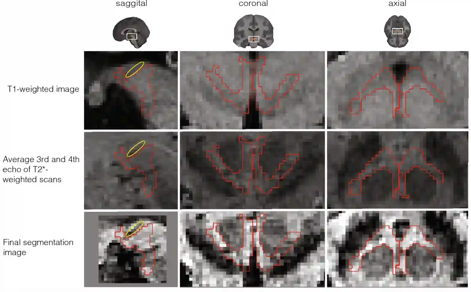 Ventral tegmental Area im MRI (VTA)