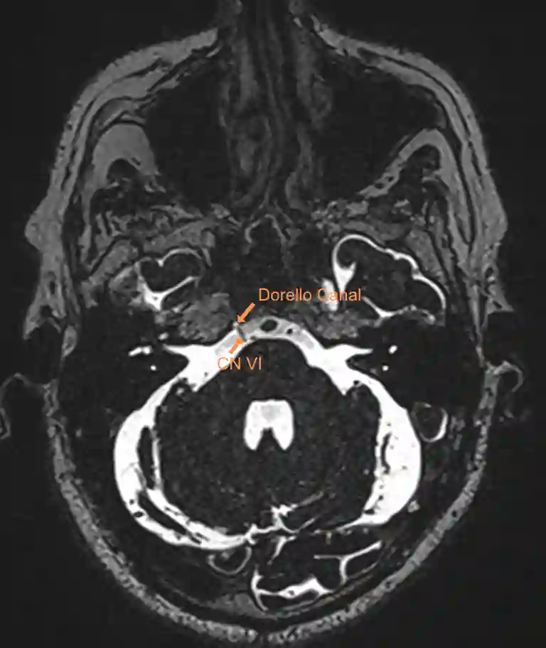 Nervus abducens und Dorello Kanal MRT