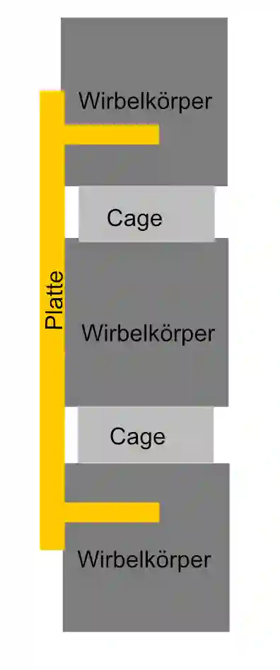 ACDF Platte Schematisch