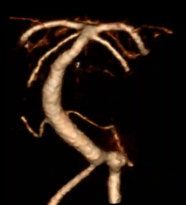 Aneurysma Arteria vertebralis