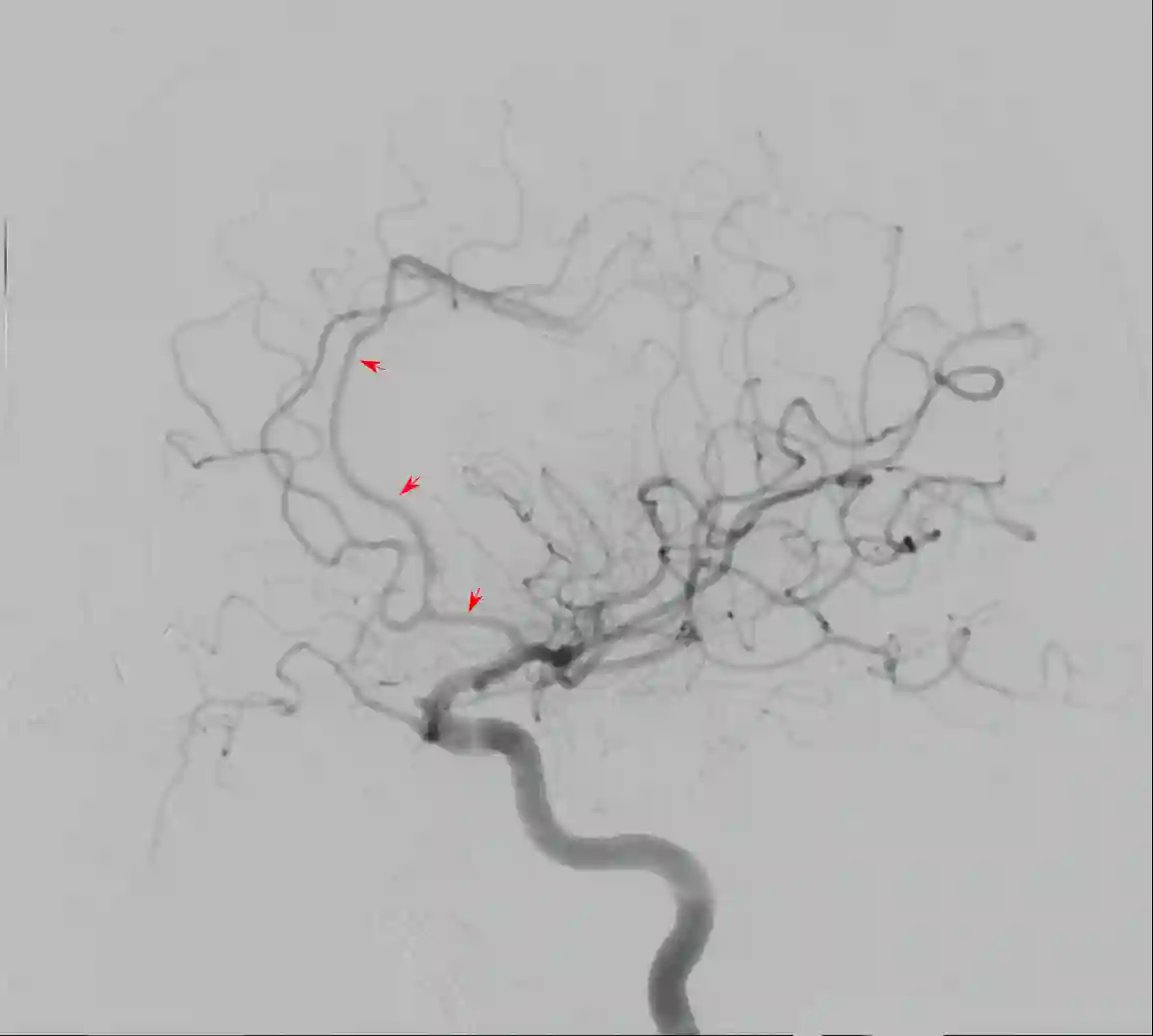 Arteria cerebri anterior DSA