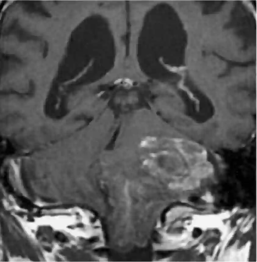 Cerebelläres Liponeurozytom T1 mit Kontrastmittel MRT