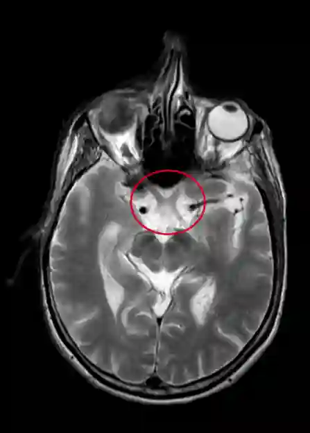Chiasma opticum im MRT