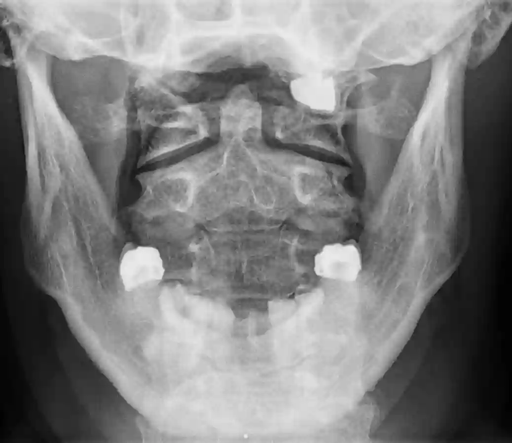 Dens Axis im Röntgen transoral