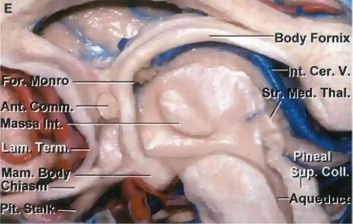 Dritter Ventrikel Sagittal