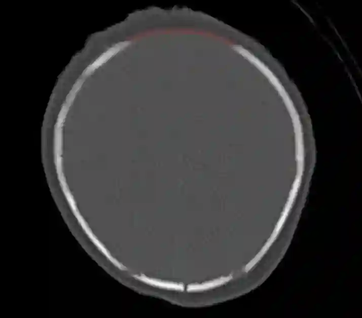 Fonticulus anterior axiales CT