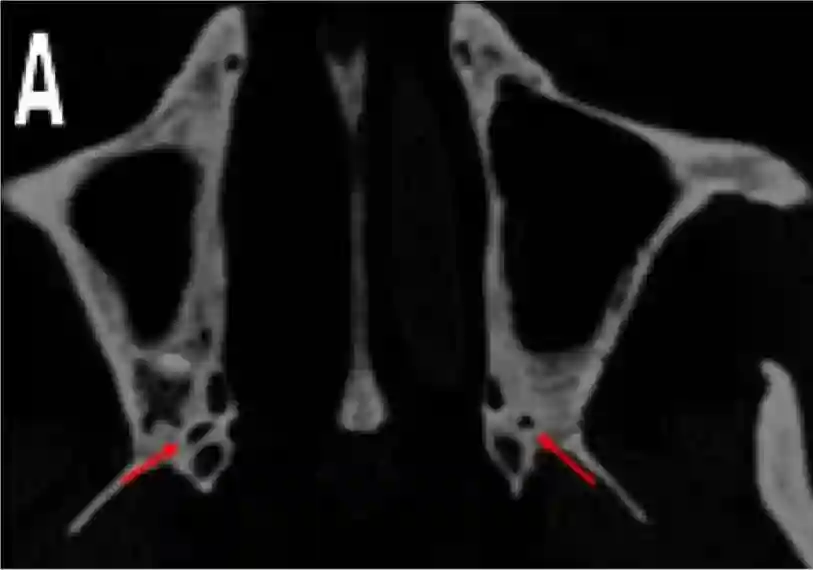 Foramen palatinum minor im CT