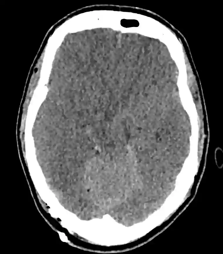 Generalisiertes Hirnödem CT