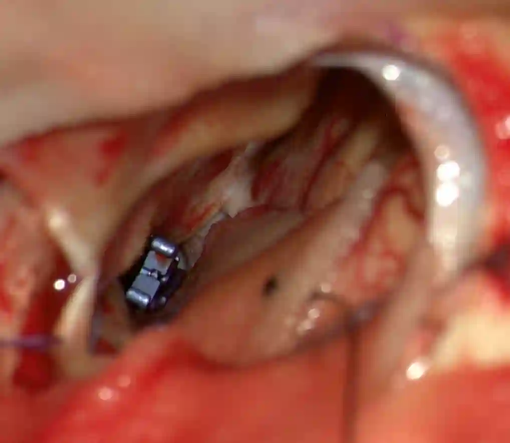 Lazic Clip Intraoperativ